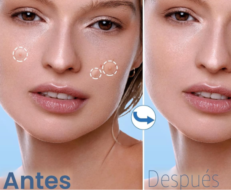 Parches Quita Granos Sin Dejar Marca